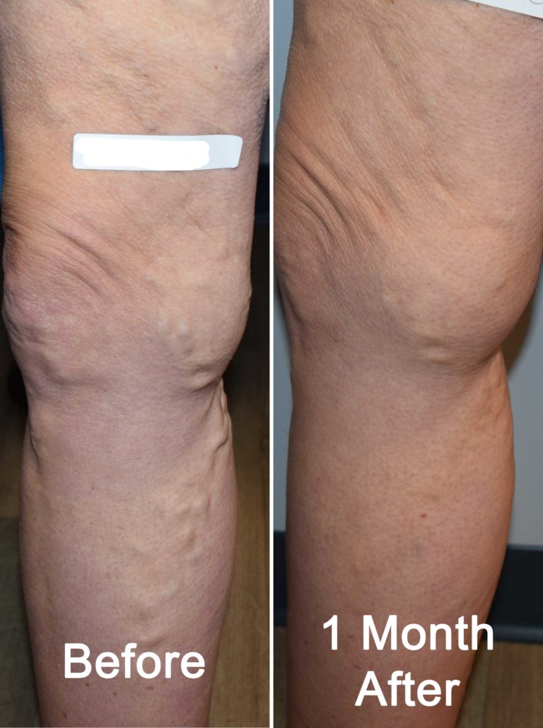 Varicose Vein Treatment Before And After Photos Advanced Vein