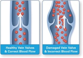 healthy vein