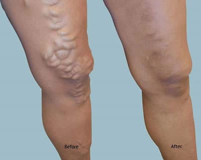 before and after vein surgery