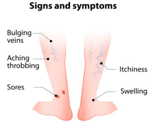 varicose veins signs