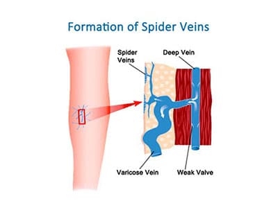 spider veins formation