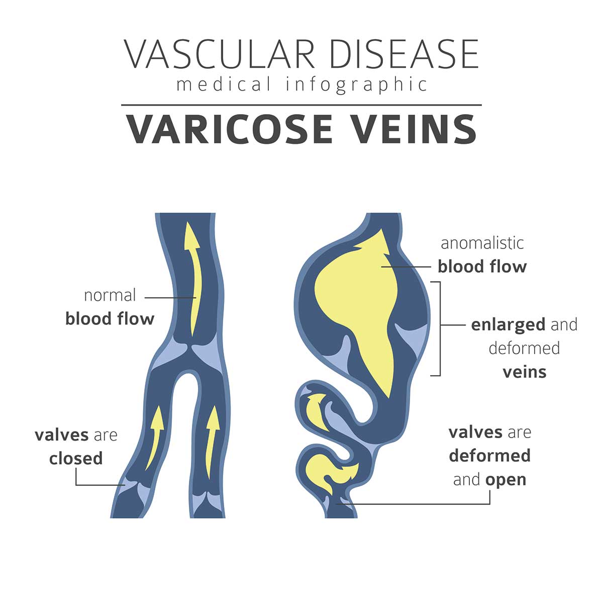 Vulvar Varicosities: Causes, Symptoms, Diagnosis & Treatment